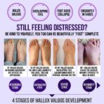 NEW Hallux Valgus Bunion Corrector for Women and Men Orthopedic Bunion Toe Straightener Adjustable Bunion Splint(JD025T) - Image 5